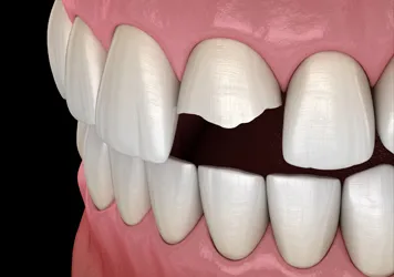 Cracked Tooth