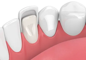 Veneers