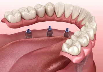 Dentures