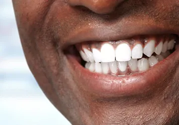 Teeth Whitening